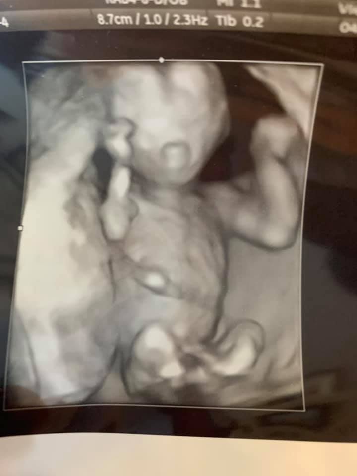 ultrasound of tubal reversal baby #2 from oklahoma