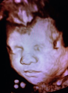 ultrasound of Stephanie Manning's tubal reversal baby