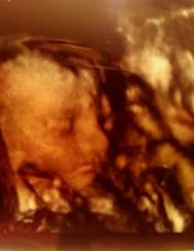ultrasound of the first tubal reversal baby due to the martins of lovington new mexico