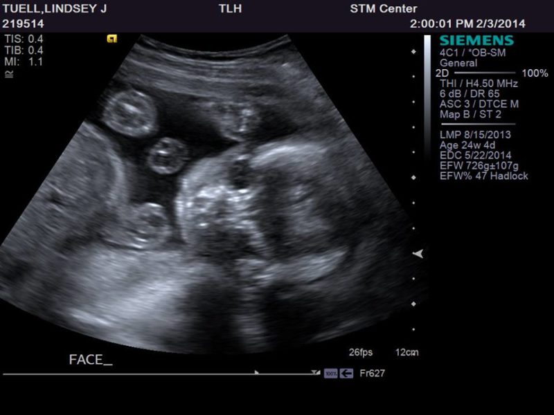 ultrasound of tubal reversal baby for lindsey Tuell