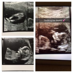 pregnancy ultrasound from Sara Garcia of illinois after a tubal reversal