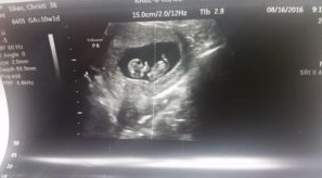 shell sikes ultrasound of her future tubal reversal baby