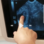 my tubal reversal baby ultrasound