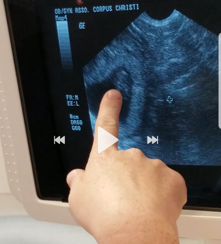 my tubal reversal baby ultrasound