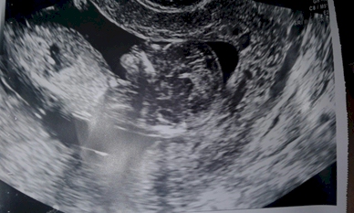 Holly Barry from Pawtucket, Rhode Island shares her ultrasound of her tubal reversal pregnancy