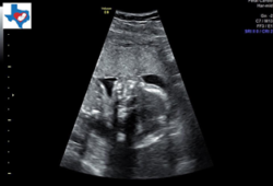 ultrasound of tubal reversal baby for Crystal Moreno