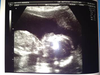 ultrasound of our tubal reversal baby