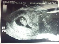 ultrasound of Monica Alaniz's Tubal Reversal baby