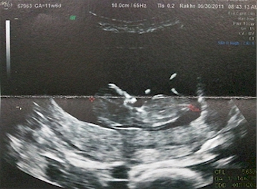 ultrasound of a tubal reversal baby for c evans