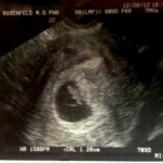 ultrasound of pregnant Tubal Reversal patient lucero benavides of Houston Texas