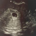 ultrasound image of michelle pelayo's second Tubal Reversal baby
