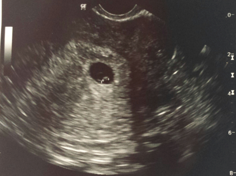 ultrasound image of michelle pelayo's second Tubal Reversal baby