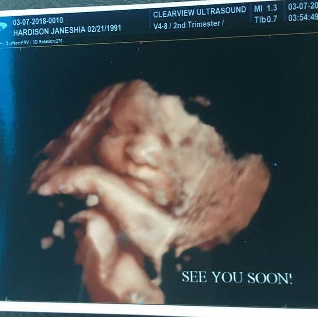 janeshia hardison shared this tubal reversal baby ultrasound in march 2018 about 3 weeks before baby is due