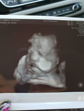 3d ultrasound of tubal reversal baty due may 2018 to jennifer hagy of pomona california