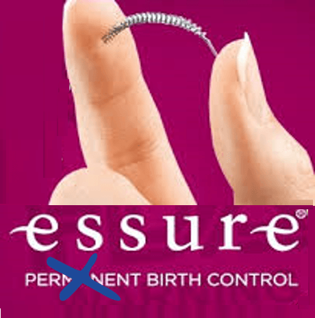 essure is nozt permanent birth control, reversal is possible