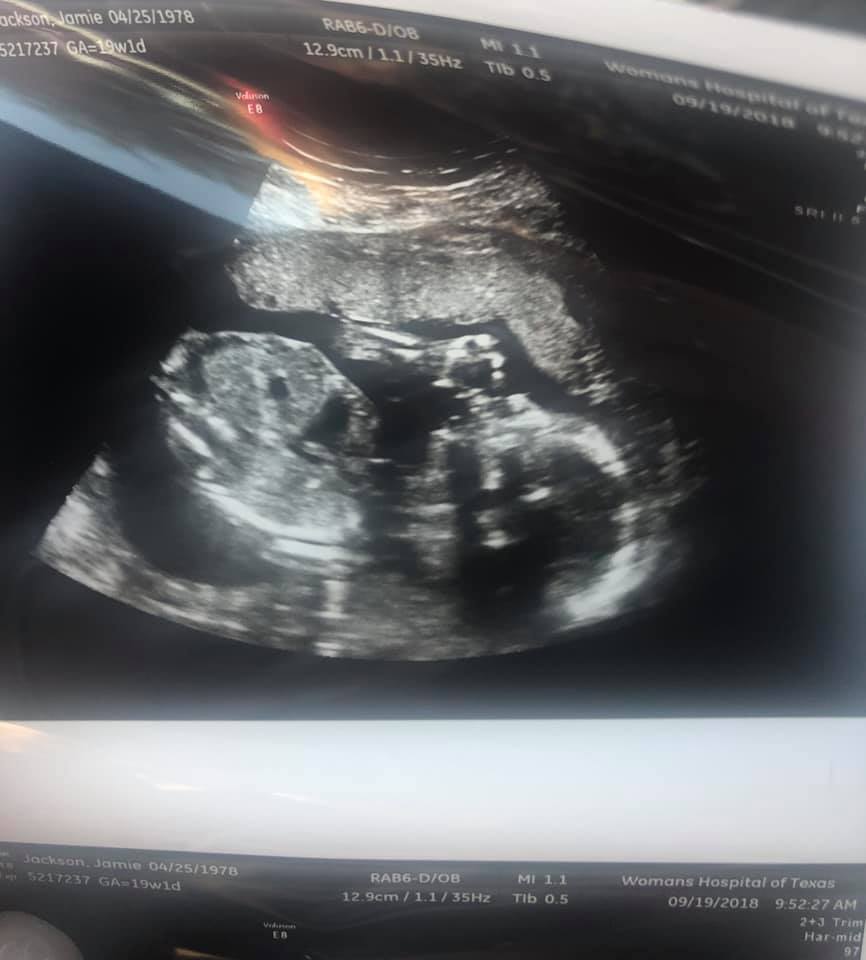 40-year-old mom-to-be, jamie jackson shares the ultrasound of her tubal reversal baby from september 2018