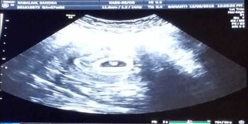 ultrasound of sandra ann rabalais showing her tubal reversal resulted in a pregnancy more than 3 years after her TR surgery