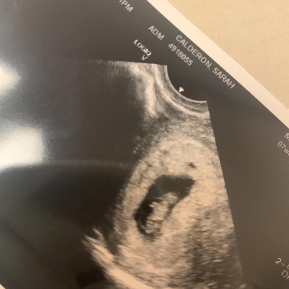 ultrasound from sarah calderon announcing she is pregnant one month after a tubal reversal by dr rosenfeld
