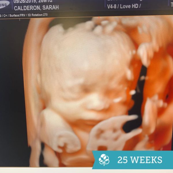 ultrasound of sarah calderon's tubal reversal baby at 25 weeks