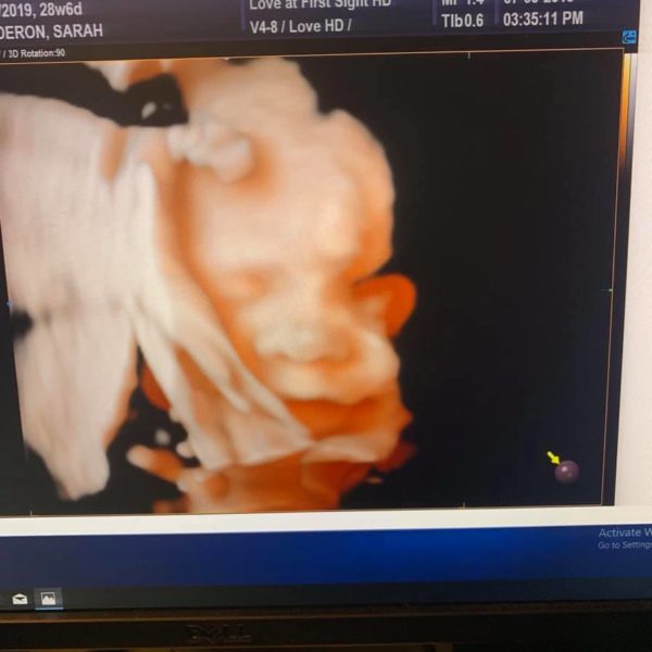 ultrasound of sarah calderon's tubal reversal baby at 28 weeks