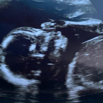 saul and silvia calderon announce they are pregnant after a tubal reversal by sharing this ultrasound of their baby in the womb
