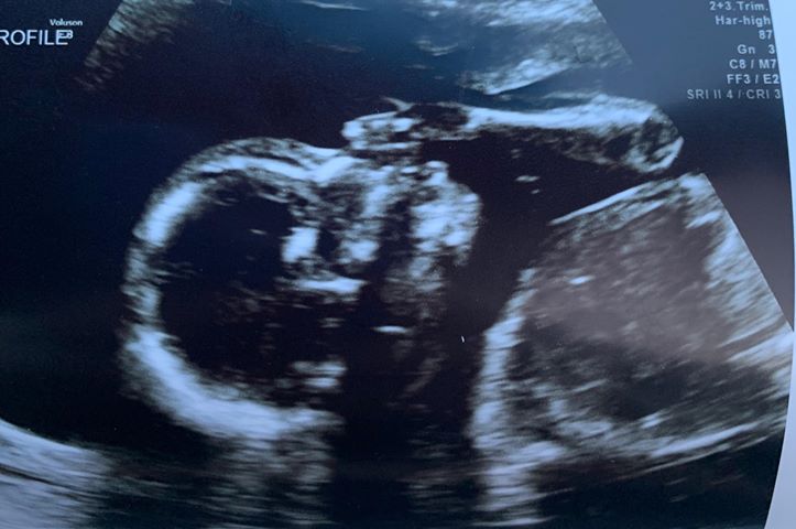 saul and silvia calderon announce they are pregnant after a tubal reversal by sharing this ultrasound of their baby in the womb