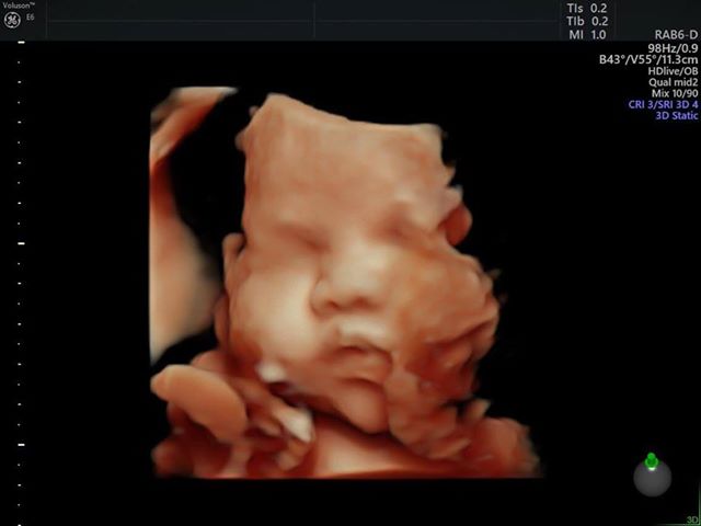 hon do tubal reversal baby girl ultrasound after her tubal reversal surgery in 2015
