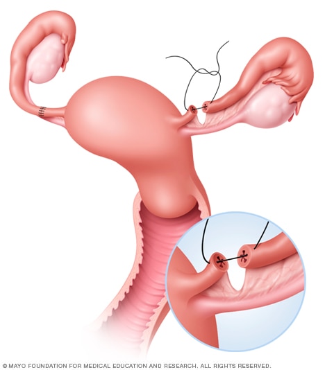 illustration of a tubal reversal where a doctor creates a reconnection of fallopian tubes