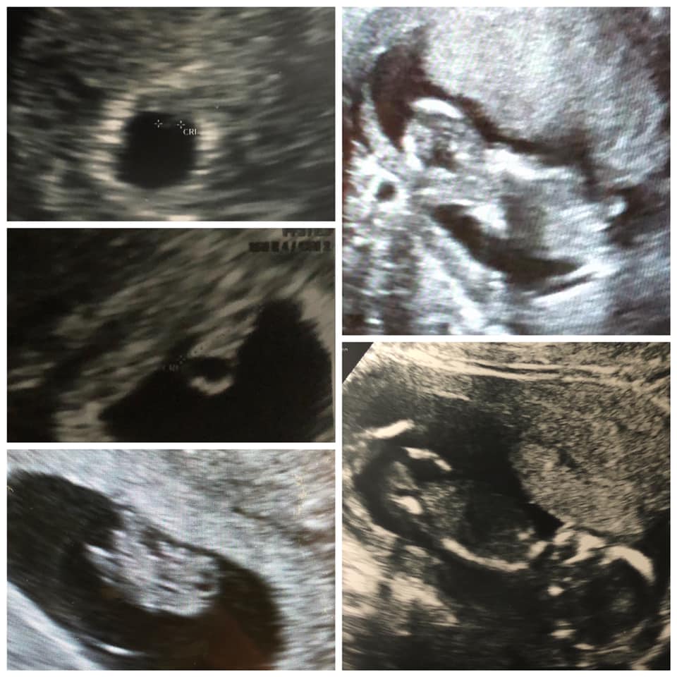 ultrasound images of mely garcia's tubal reversal pregnancy