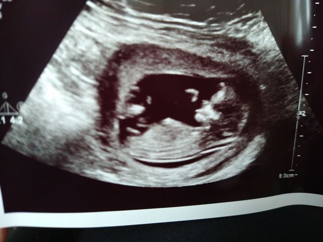 ultrasound of daniela arthur's second tubal reversal baby