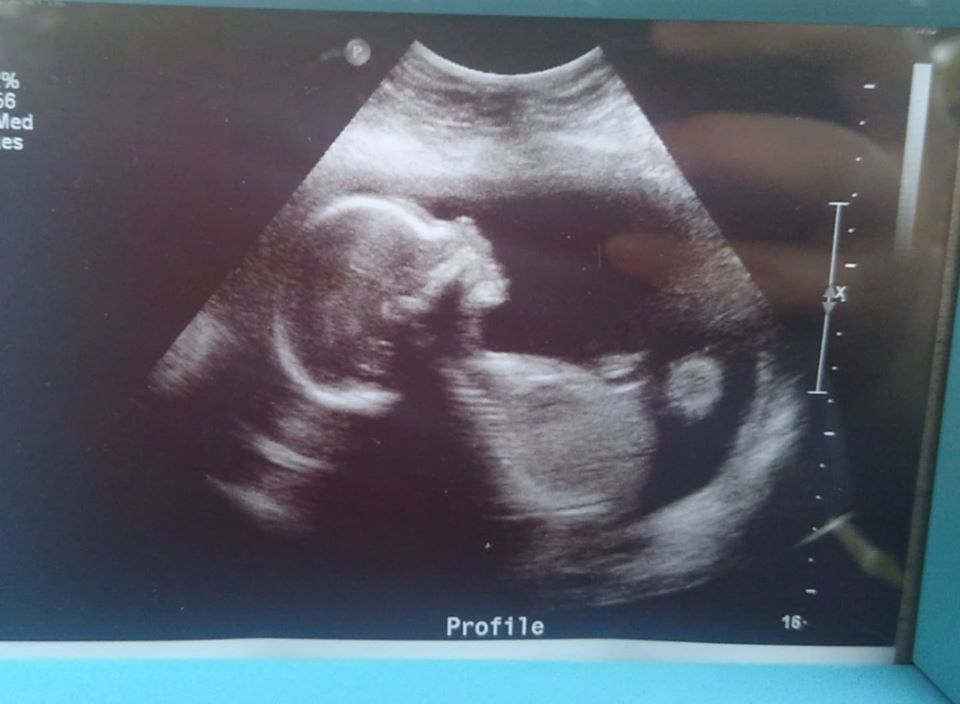 ultrasound of tubal reversal baby of daniela arthur of houston