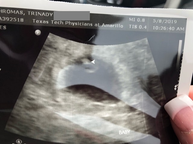 ultrasound of trinady arnold's tubal reversal baby