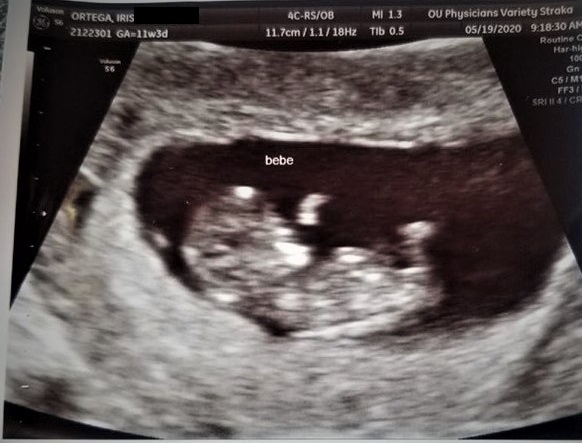 iris ortega's ultrasound of her pregnancy after tubal reversal