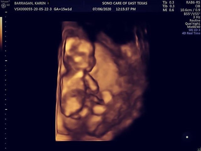 ultrasound of karen barragan's pregnancy after tubal reversal with dr. rosenfeld