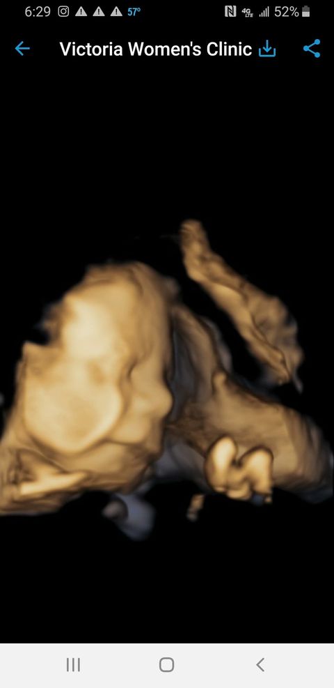 ultrasound of candy mcwhorter castillo's second tubal reversal baby, a girl named dallas