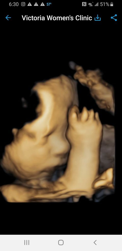 22-week ultrasound of candy mcwhorter castillo's second tubal reversal baby, a girl named dallas