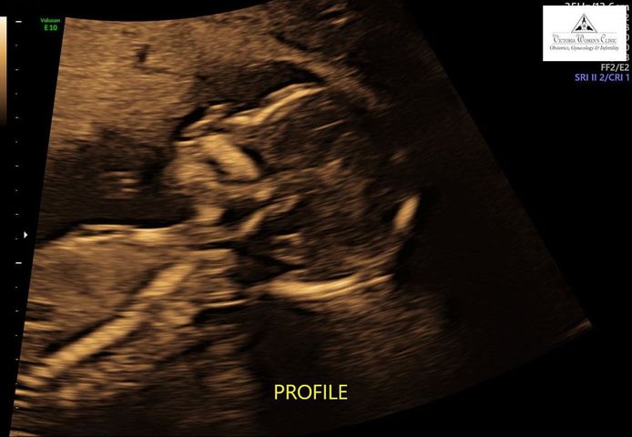 ultrasound of candy mcwhorter's second tubal reversal baby and it is a girl after 4 boys