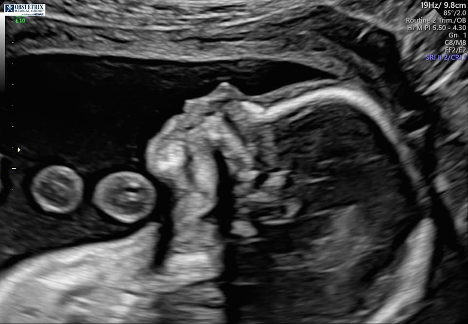 ultrasound of chaston blackburn's tubal reversal baby due february 2021