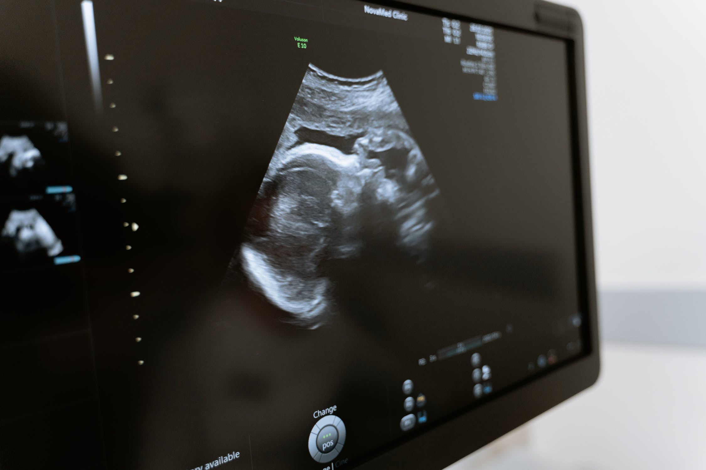 ultrasound of heather modesto's 5th tubal reversal baby