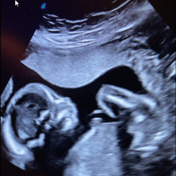 ultrasound of amanda duque baby boy that will be born in april 2022 after tubal reversal with doctor rosenfeld
