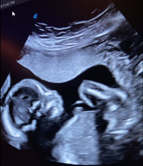 ultrasound of amanda duque baby boy that will be born in april 2022 after tubal reversal with doctor rosenfeld