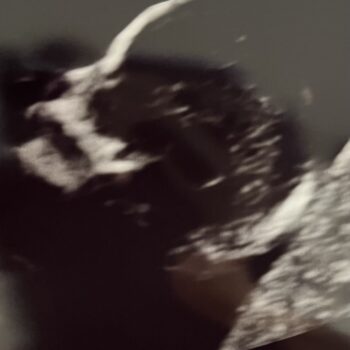 ultrasound of sandra cruz's tubal reversal baby