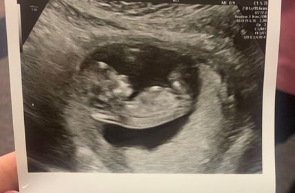 ultrasound image of amalie lopez's pregnancy after tr surgery with doctor rosenfeld
