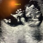 janie martinez' ultrasound image of her first tubal reveresal baby after tubal reversal with doctor rosenfeld