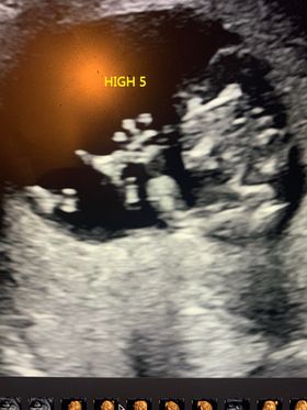 janie martinez' ultrasound image of her first tubal reveresal baby after tubal reversal with doctor rosenfeld