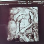 ultrasound of sandy matice's tubal reversal baby after an october 2021 reversal with dr rosenfeld