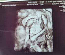 ultrasound of sandy matice's tubal reversal baby after an october 2021 reversal with dr rosenfeld