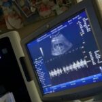 amanda pedersen's 11-week ultrasound of her tubal reversal baby
