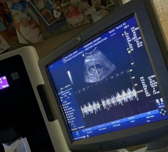 amanda pedersen's 11-week ultrasound of her tubal reversal baby