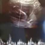 marylee hernandez tubal reversal baby pregnancy ultrasound